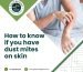 how to know if you have dust mites on skin